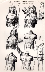 Mellrák műtéte, Johannes Schultes (1595-1645) Armamentarii Chirurgici című művéből, Amszterdamban kiadva, 1672