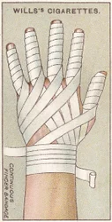 Folyamatos ujjkötés, 48. sz. a Willss Cigarettes kártya elsősegély-sorozatából, 1913