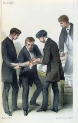 Egy kar amputálása, Jean-Baptiste-Leon Dubreuil orvosi kézikönyvéből, 1850-60 körül
