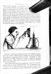 Illusztráció a „Traite Pratique des Maladies des Yeux”, „A Manual on the Principles and Practice of Ophthalmic Medicine and Surgery” fordítása, Thomas Wharton Jones (1808-91), E. Foucher, kiadva Párizsban 1862 (metszet) (sz. /w fotó)