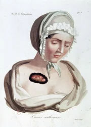 Antracin rák – Alibert, B.N.