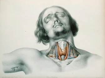A torok keresztmetszete, Jean-Baptiste-Leon Dubreuil „Anomalies Arterielles” című művéből