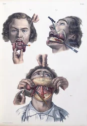 Műtét az alsó állkapcson, Jean-Baptiste Marc Bourgery (1797-1849) „Traite Complet de l