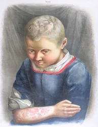 Favus, Daniel Cornelius Danielssen (1815-94) könyvéből, 1892