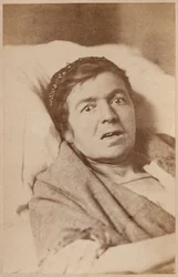 Hisztérikus epilepszia, arcösszehúzódás, VIII. lemez az „Iconographie Photographique de La Salpetriere”-ből, Bourneville és P. Regnard, Párizs, 1876 (albumnyomat)
