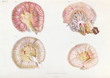 A kolerával fertőzött belek külső felülete az Anatomie Pathologique du Cholera Morbus-tól, Nyikolaj Ivanovics Pirogov (1810-81) Szentpéterváron, 1849