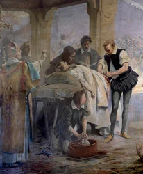 Az orvos Ambroise Pare (1509-1590) gyakorolja az artériák lekötését egy olyan harquebusheren, amely megsérült Metz V. Károly 1553-as ostroma során. Theobald Chartran festménye (1849-1907)
