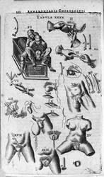Sebészeti beavatkozások női és férfi nemeken. J. Scultetus, Velence, „Armamentarium Surgical” metszete