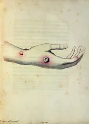 Tehénhimlő pustule Sarah Nelmes karján, Edward Jenner (1749-1823) „A Variolae Vaccinae okainak és következményeinek vizsgálata” című könyvéből, Pearce metszetében, 1800 körül